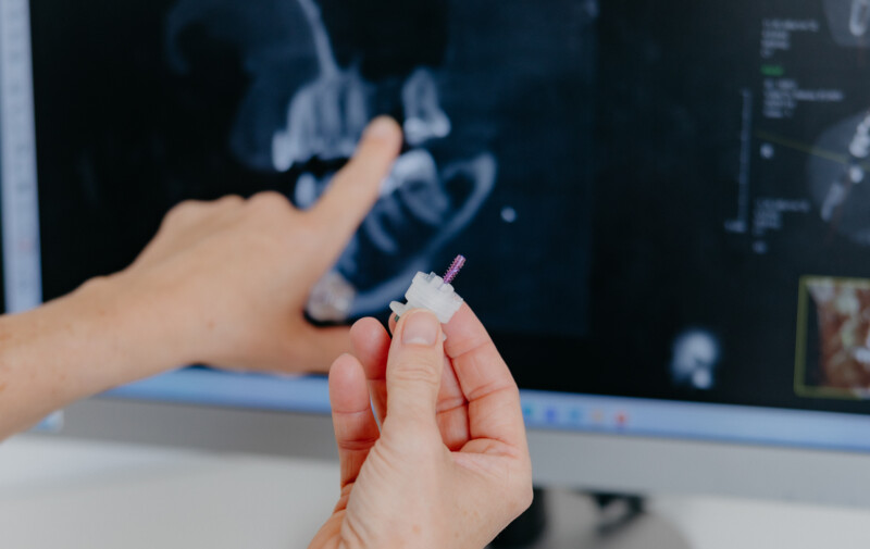 Hand h&auml;lt ein kleines, wei&szlig;-lila Zahnimplantat-Teil und zeigt auf ein 3D-R&ouml;ntgenbild des Kiefers am Monitor.